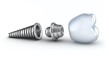 An illustration of a dental implants in Burnaby