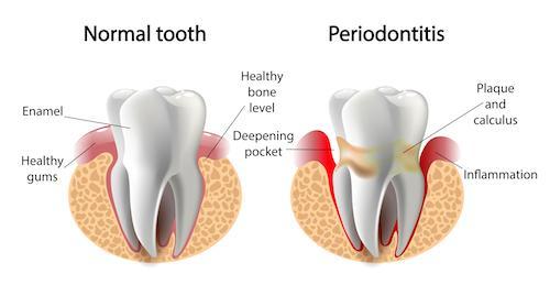 Diagram of healthy and sick gums