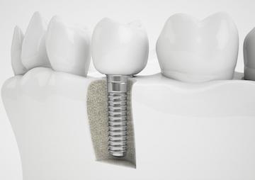 Dental implant illustration
