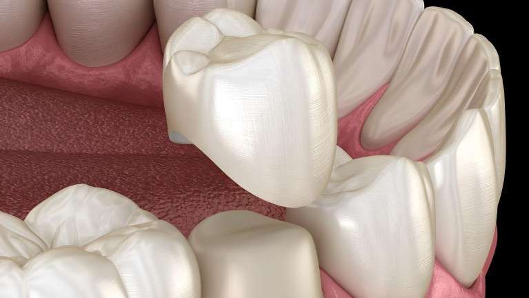 An illustration of a Dental Crowns in Burnaby, BC?