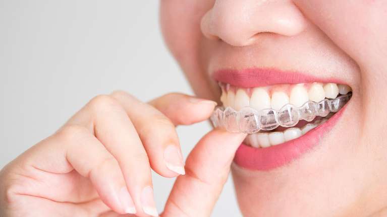 A lady trying out Clear Aligners in Burnaby, BC