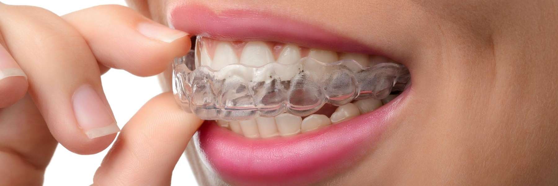 a straightened Smiles with Invisalign in Burnaby, BC