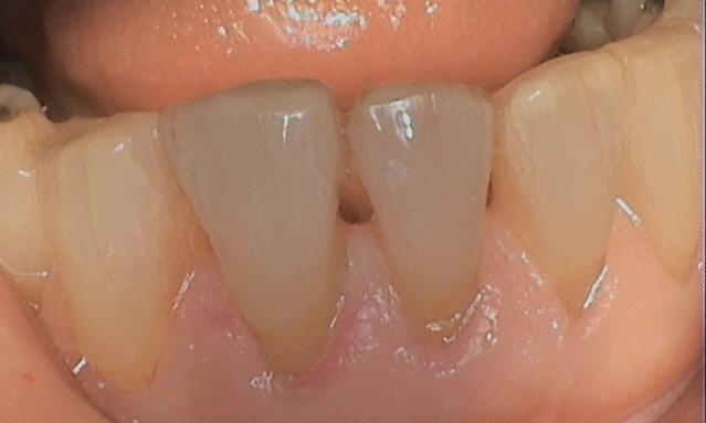Spaces in between lower front teeth | Central Park Dental Clinic