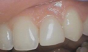 Bioclear Treatment used to increase size of lateral incisor | Central Park Dental Clinic