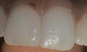 Bioclear used to fill space between front teeth | Dentist Burnaby BC