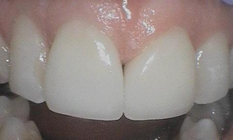 Dental Crowns to restore front teeth | Dentist Burnaby BC