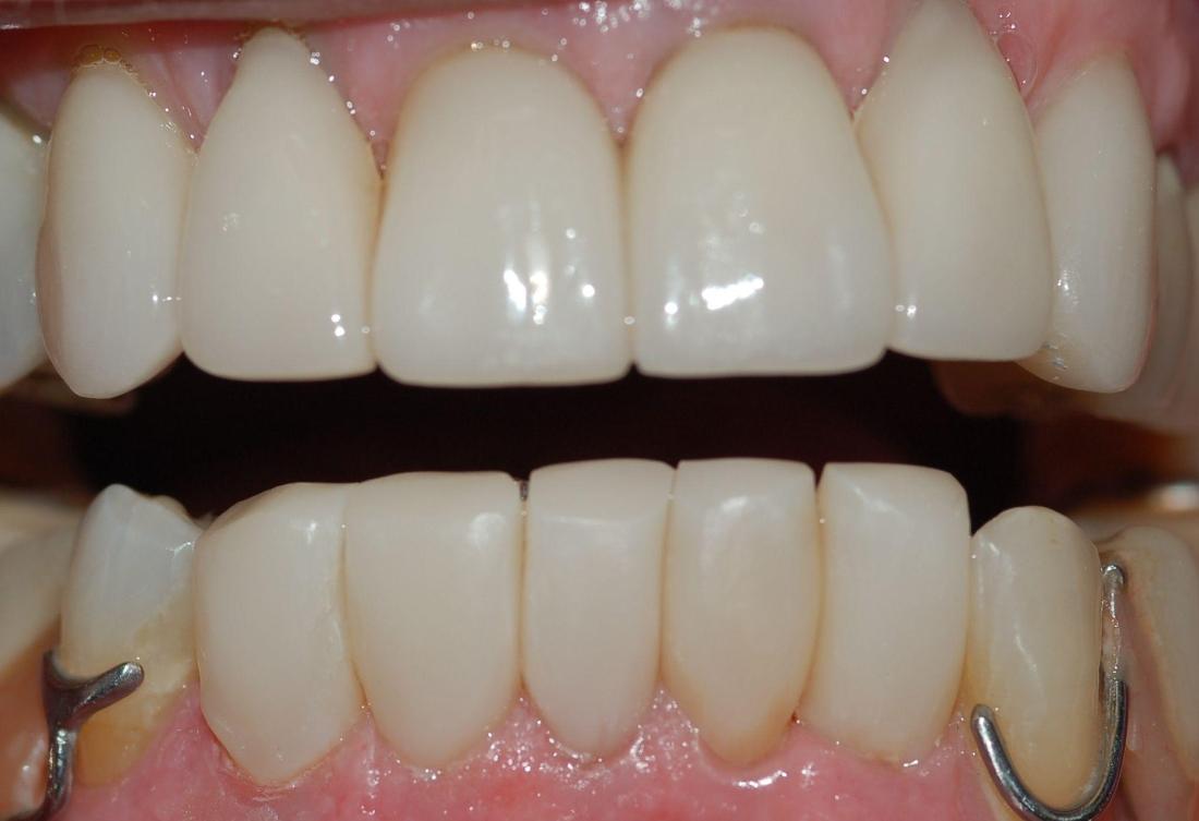 Bottom teeth have been restored using bioclear technology