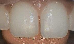 Space between front teeth | Dentist Burnaby BC