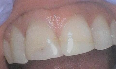 Front teeth with discolouration | Dentist Burnaby BC