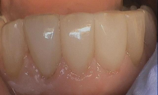 BioClear-Treatment-After-Image