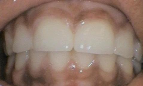 Broken-front-teeth-with-large-gap-between-them-After-Image
