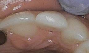 Photo shows top of lateral incisor after Bioclear Treatment | Dentist Burnaby BC