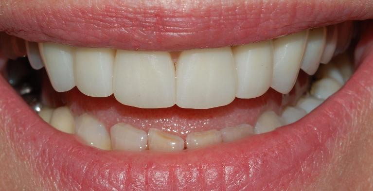 Crowns used on the top front teeth