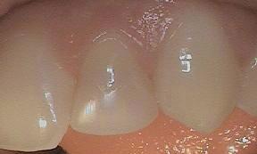 Smaller Lateral incisor | Dentist Burnaby BC