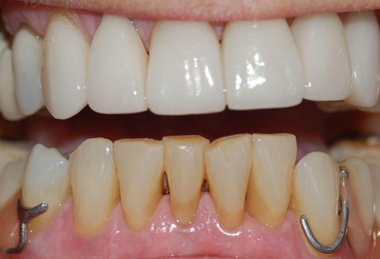 Bottom teeth are discoloured and misaligned