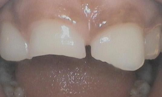 Broken-front-teeth-with-large-gap-between-them-Before-Image