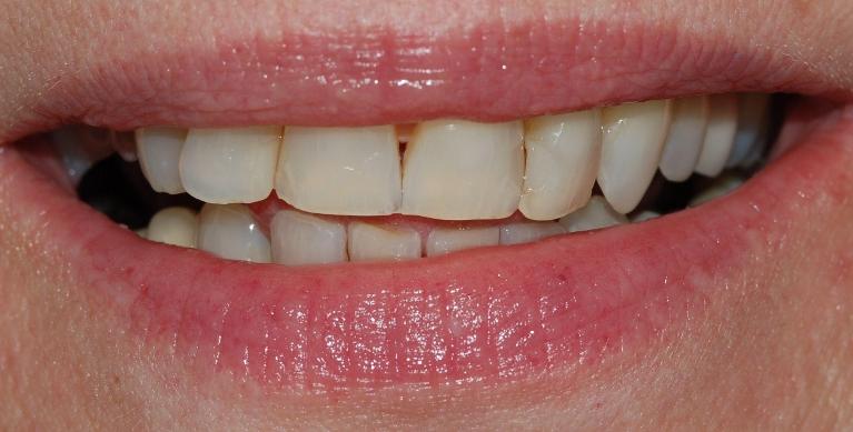 Small gap in front teeth and slightly discoloured
