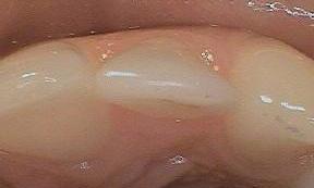 Photo shows top of lateral incisor | Dentist Burnaby BC